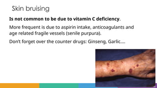 Skin bruising
Is not common to be due to vitamin C deficiency.
More frequent is due to aspirin intake, anticoagulants and
age related fragile vessels (senile purpura).
Don’t forget over the counter drugs: Ginseng, Garlic….
 