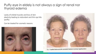 Puffy eye in eldely is not always a sign of renal nor
thyroid edema
Laxity of orbital muscles and loss of skin
elasticity leading to redundant and thin eye lids
(puffy).
Can be treated for cosmetic reasons
 