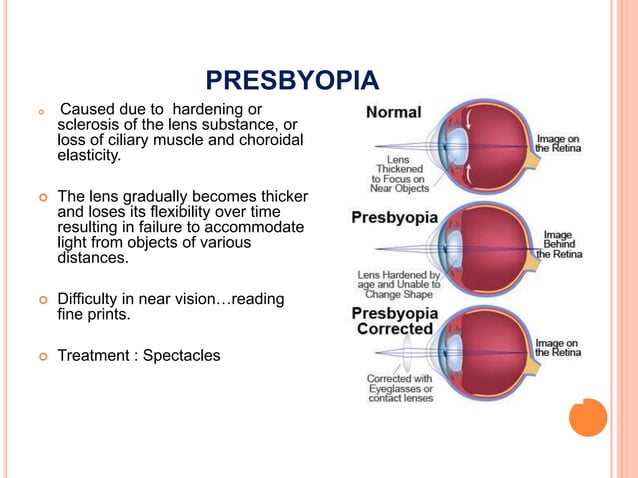 Geriatric ophthalmology | PPTX | Eye and Vision Conditions | Diseases ...