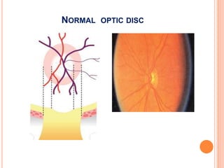 Normal Disc Eye Geriatric ophthalmology | PPTX