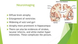  Diffuse brain atrophy
 Enlargement of ventricles
 Widening of sulci and gyri
 Atrophy more prominent in hippocampus
 There can also be evidences of strokes,
lacunar infarcts, and white matter hyper
intensities. These complicate the picture.
Neuroimaging
 