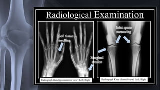 Radiological Examination
Soft tissue
swelling
Marginal
erosion
Joint space
narrowing
Radiograph Hand (postanterior view) Left; Right Radiograph Knee (frontal view) Left; Right
 