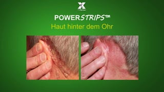 POWERSTRIPS™ 
Haut hinter dem Ohr 
 