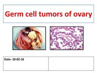 Germ cell tumors of ovary
Date- 10-02-16
 