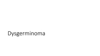 Dysgerminoma
 
