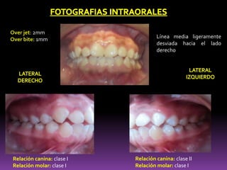 Relación canina: clase I
Relación molar: clase I
Relación canina: clase II
Relación molar: clase I
Línea media ligeramente
desviada hacia el lado
derecho
Over jet: 2mm
Over bite: 1mm
 