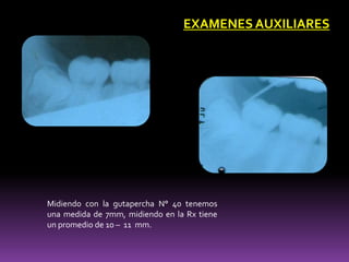 Midiendo con la gutapercha N° 40 tenemos
una medida de 7mm, midiendo en la Rx tiene
un promedio de 10 – 11 mm.
EXAMENES AUXILIARES
 