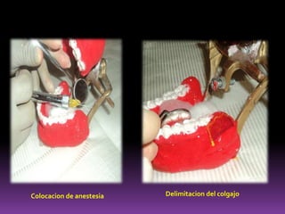 Colocacion de anestesia Delimitacion del colgajo
 