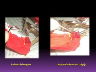 Incisión del colgajo Desprendimiento del colgajo
 