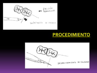 PROCEDIMIENTO
 