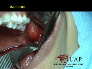 INCISION
 