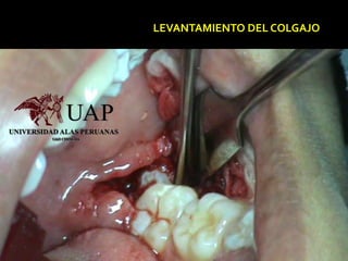 LEVANTAMIENTO DEL COLGAJO
 