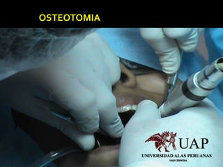 OSTEOTOMIA
 