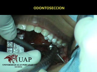 ODONTOSECCION
 