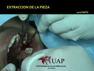 EXTRACCION DE LA PIEZA
1era PARTE
 