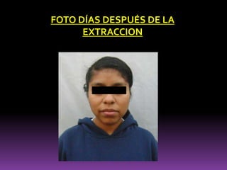FOTO DÍAS DESPUÉS DE LA
EXTRACCION
 