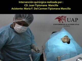 Intervención quirúrgica realizada por :
CD. JuanTipismana Mancilla
Asistente: Maria F. Del CarmenTipismana Mancilla
 