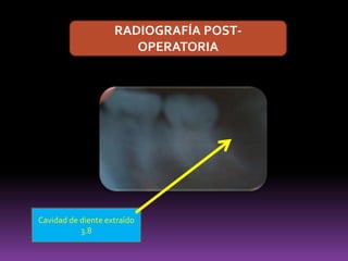 RADIOGRAFÍA POST-
OPERATORIA
Cavidad de diente extraído
3.8
 