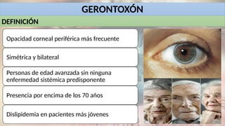 GERONTOXÓN
Opacidad corneal periférica más frecuente
Simétrica y bilateral
Personas de edad avanzada sin ninguna
enfermedad sistémica predisponente
Presencia por encima de los 70 años
Dislipidemia en pacientes más jóvenes
DEFINICIÓN
 