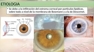 ETIOLOGIA
• Se debe a la infiltración del estroma corneal por partículas lipídicas,
sobre todo a nivel de la membrana de Bowmann y a la de Descemet.
 