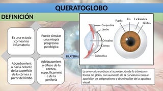 DEFINICIÓN
Es una ectasia
corneal no
inflamatoria
Puede simular
una miopía
progresiva
patológica
Abombamient
o hacia delante
de la superficie
de la córnea a
partir del limbo
Adelgazamient
o difuso de la
cornea,
específicament
e de la
periferia
QUERATOGLOBO
La anomalía conduce a la protección de la córnea en
forma de globo, con aumento de la curvatura corneal
aparición de astigmatismo y disminución de la agudeza
visual.
BILATERAL
 