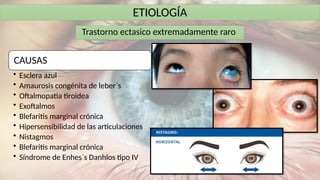 ETIOLOGÍA
Trastorno ectasico extremadamente raro
CAUSAS
• Esclera azul
• Amaurosis congénita de leber`s
• Oftalmopatia tiroidea
• Exoftalmos
• Blefaritis marginal crónica
• Hipersensibilidad de las articulaciones
• Nistagmos
• Blefaritis marginal crónica
• Síndrome de Enhes`s Danhlos tipo IV
 