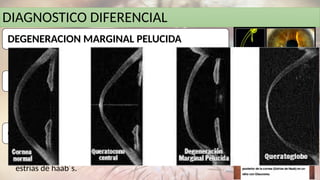 DIAGNOSTICO DIFERENCIAL
DEGENERACION MARGINAL PELUCIDA
• Adelgazamiento corneal inferior, bilateral en forma de
media luna
MEGALOCORNEA
• Diámetro corneal mayor a 12.5 mm, no hay
adelgazamiento ni protucción, astigmatismo mínimo, no
hay presencia de hidrops ni cicatrices.
GLAUCOMA CONGENITO
• Diámetro corneal mayor a 12.5 mm, edema, hay una ligera
protucción, un ligero astigmatismo, encuentra hidrops, y
estrías de haab´s.
 