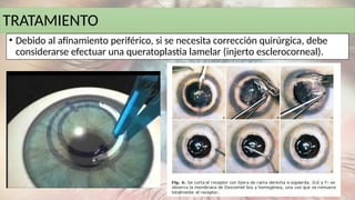 TRATAMIENTO
• Debido al afinamiento periférico, si se necesita corrección quirúrgica, debe
considerarse efectuar una queratoplastia lamelar (injerto esclerocorneal).
 