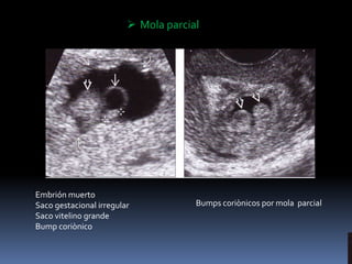  Mola parcial
Embrión muerto
Saco gestacional irregular
Saco vitelino grande
Bump coriònico
Bumps coriònicos por mola parcial
 