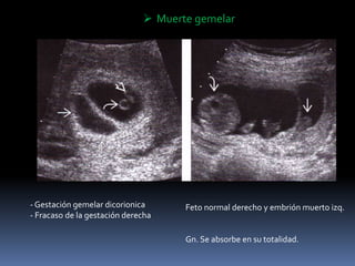  Muerte gemelar
- Gestación gemelar dicorionica
- Fracaso de la gestación derecha
Feto normal derecho y embrión muerto izq.
Gn. Se absorbe en su totalidad.
 