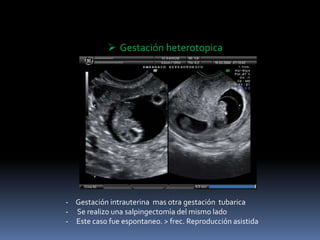  Gestación heterotopica
- Gestación intrauterina mas otra gestación tubarica
- Se realizo una salpingectomìa del mismo lado
- Este caso fue espontaneo. > frec. Reproducción asistida
 