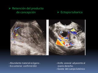 - Abundante material ecógeno .
- Eco anterior confirmó GIU
 Retención del producto
de concepción
- Anillo anexial adyacente al
ovario derecho.
- Quiste del cuerpo luteìnico
 Ectopia tubarica
 