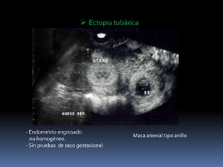 - Endometrio engrosado
no homogéneo.
- Sin pruebas de saco gestacional
 Ectopia tubàrica
Masa anexial tipo anillo
 