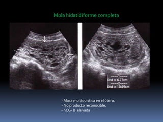 Mola hidatidiforme completa
- Masa multiquistica en el útero.
- No producto reconocible.
- hCG- B elevada
 