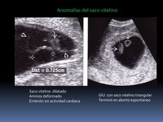 Saco vitelino dilatado
Amnios deformado
Embrión sin actividad cardiaca
Anomalías del saco vitelino
GIU con saco vitelino triangular.
Terminó en aborto espontaneo
 
