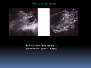 Aborto espontaneo
Embrión amorfo de 8 semanas
Saco en cérvix con OCI abierto
 