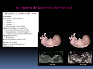 Aumento de la translucidez nucal
 
