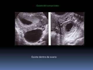 Quiste del cuerpo luteo
Quiste dentro de ovario
 