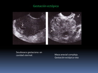 Gestación ectópica
Seudosaco gestaciona en
cavidad uterinal. Masa anexial compleja.
Gestación ectópica rota
 