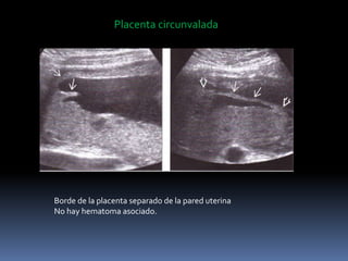 Placenta circunvalada
Borde de la placenta separado de la pared uterina
No hay hematoma asociado.
 