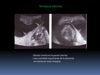 Sinequia uterina
- Banda inserta en la pared uterina
- Una cantidad importante de la placenta
se inserta en esta sinequia
 