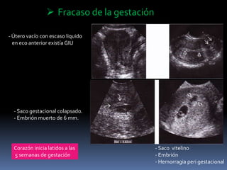  Fracaso de la gestación
- Útero vacío con escaso liquido
en eco anterior existía GIU
- Saco gestacional colapsado.
- Embrión muerto de 6 mm.
- Saco vitelino
- Embrión
- Hemorragia peri gestacional
Corazón inicia latidos a las
5 semanas de gestación
 