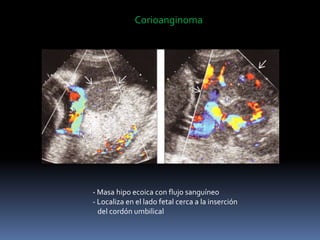 Corioanginoma
- Masa hipo ecoica con flujo sanguíneo
- Localiza en el lado fetal cerca a la inserción
del cordón umbilical
 