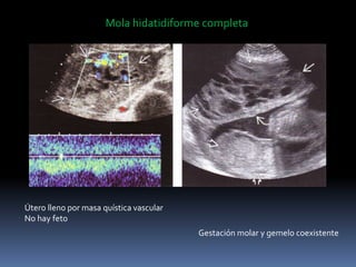Mola hidatidiforme completa
Útero lleno por masa quística vascular
No hay feto
Gestación molar y gemelo coexistente
 