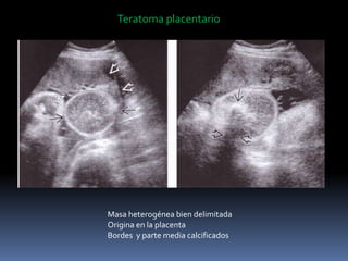 Teratoma placentario
Masa heterogénea bien delimitada
Origina en la placenta
Bordes y parte media calcificados
 