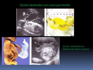 Quiste alantoideo con uraco permeable
Quiste alantoideo con
Gelatina de warton quística
 