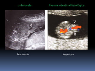 onfalocele Hernia intestinal fisiológica
Permanente Regresiona
 