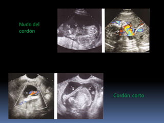 Nudo del
cordón
Cordón corto
 