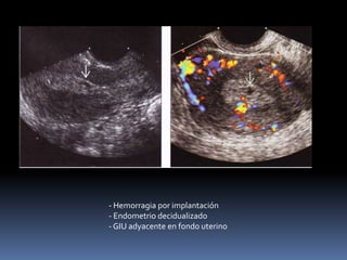 - Hemorragia por implantación
- Endometrio decidualizado
- GIU adyacente en fondo uterino
 