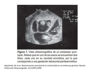 Sepúlveda, W. et al. Determinación prenatal de la corionicidad en el embarazo gemelar. Revista
Chilena de Ultrasonografía....